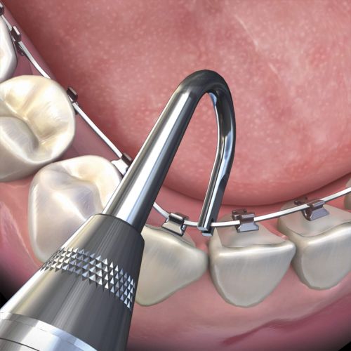 Hu-friedy_Lingual Torquing Key with Picker_Quintess-Denta