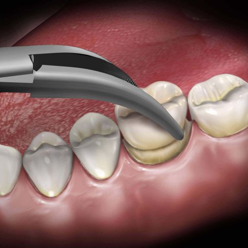 Hu-friedy_Temporary Crown Remover_Quintess-Denta