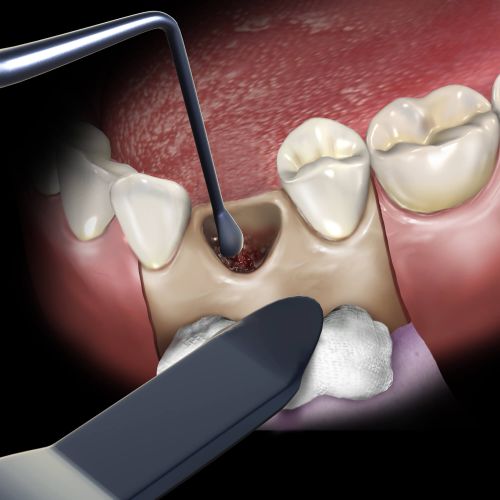 Hu-friedy_Retractor U of Minn. Black Line_Quintess-Denta