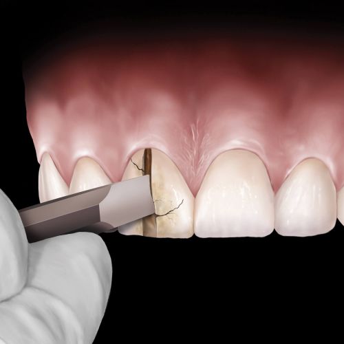 Hu-friedy_Straight Goldstein Crown Remover_Quintess-Denta