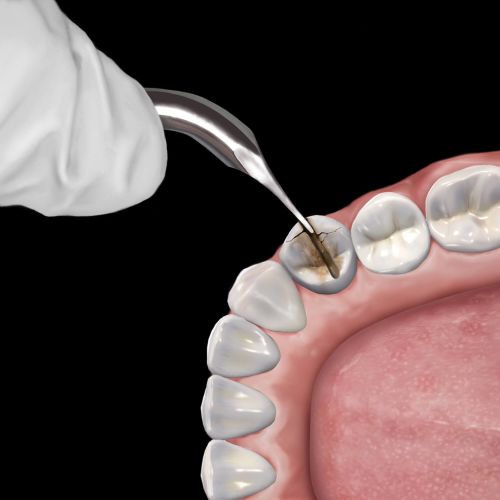 Hu-friedy_Goldstein Crown Remover, 45°_Quintess-Denta