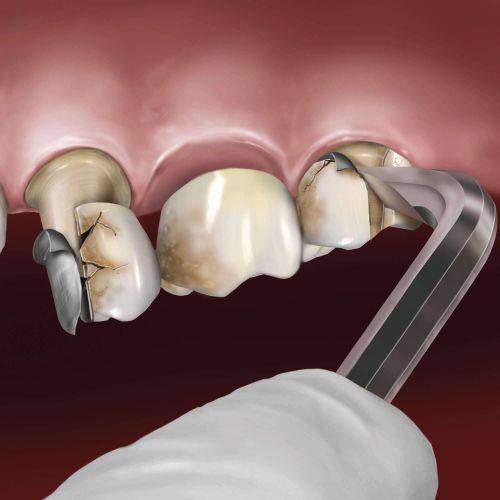 Hu-friedy_Goldstein Crown Remover, 90°_Quintess-Denta