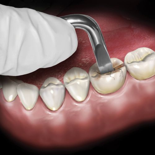 Hu-friedy_Occlusal Surface Goldstein Crown Remover_Quintess-Denta