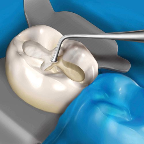 Hu-friedy_11 Novatech™ Placement Instrument_Quintess-Denta