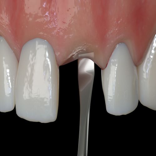 Hu-friedy_PM Edge Crestal Bone Chisel, Short, EverEdge™ 2.0_Quintess-Denta