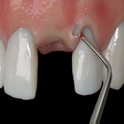 Hu-friedy_PM Nanos A (Angulated), EverEdge™ 2.0, Perio Knife_Quintess-Denta