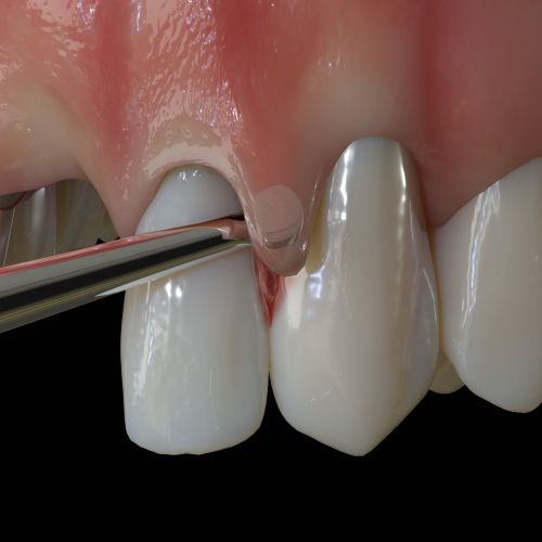 Hu-friedy_PM Nanos S (Straight), EverEdge™ 2.0, Perio Knife_Quintess-Denta