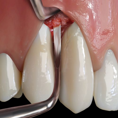 Hu-friedy_PM Prodigy Surgical Curette, Short, EverEdge™ 2.0_Quintess-Denta