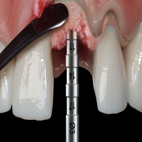 Hu-friedy_PM Split Periosteal, Short, Black Line_Quintess-Denta