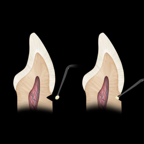 Hu-friedy_Goldstein Micro Placement Instrument_Quintess-Denta