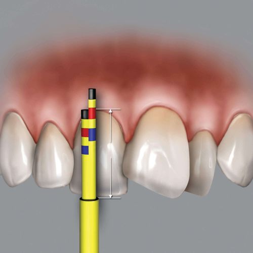 Hu-friedy_Inline Replacement Tips (3 Tips)_Quintess-Denta